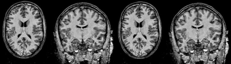 Brain Compartment Image