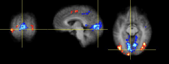 EEG-FMRI Result