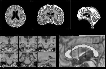 Atrophy Segmentation